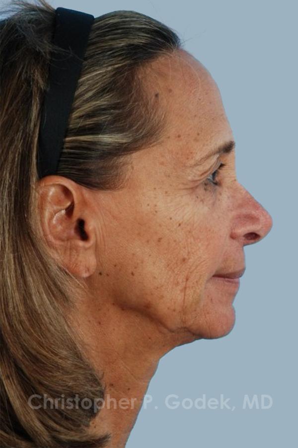 Facelift  Before & After Image