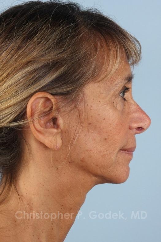 Facelift  Before & After Image