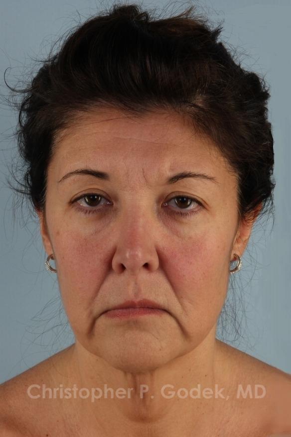 Facelift  Before & After Image