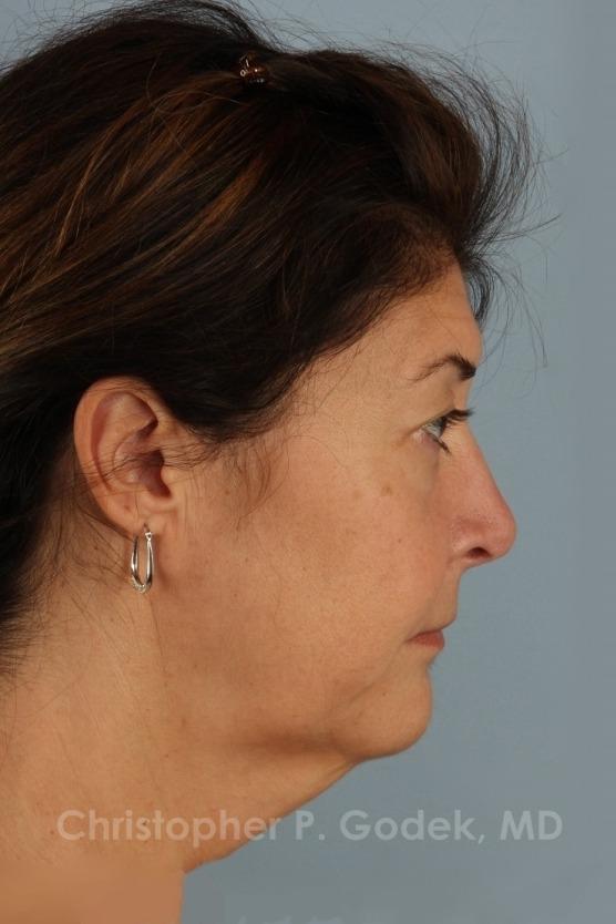 Facelift  Before & After Image