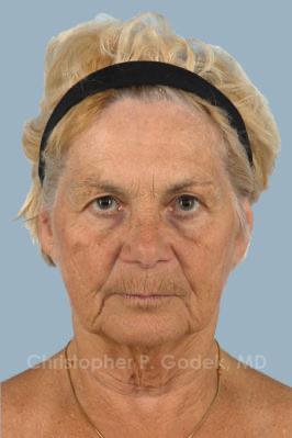 Facelift  Before & After Image