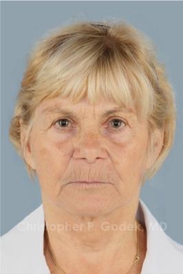 Facelift  Before & After Image