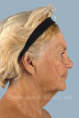 Facelift  Before & After Image