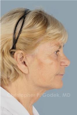 Facelift  Before & After Image