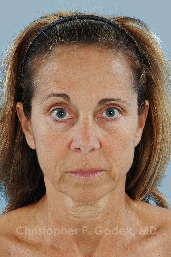 Facelift  Before & After Image