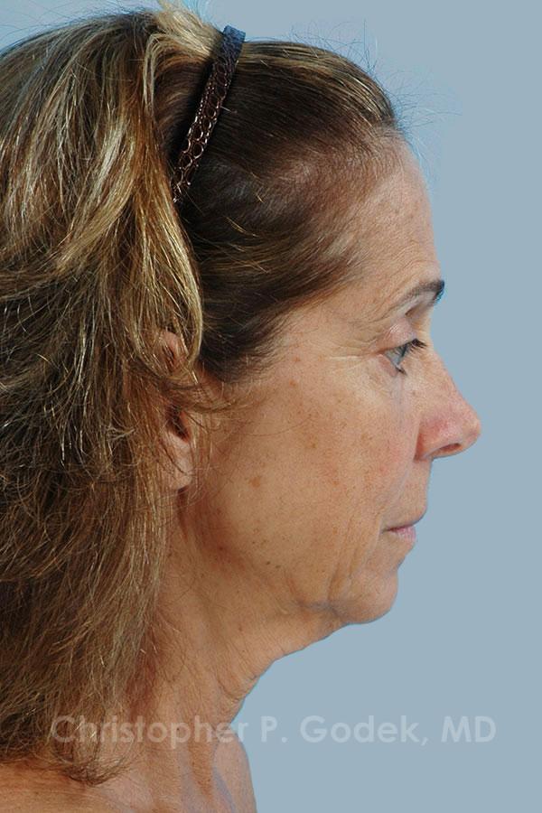 Facelift  Before & After Image