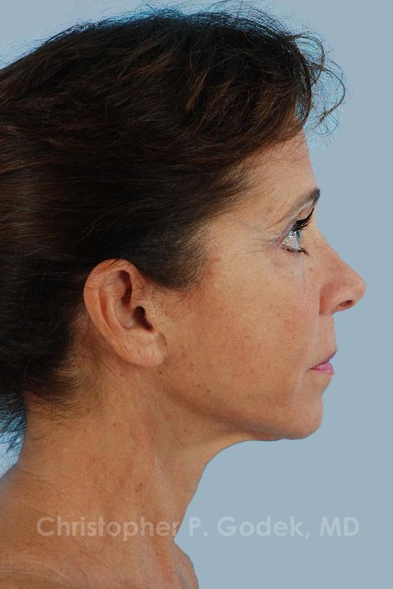 Facelift  Before & After Image