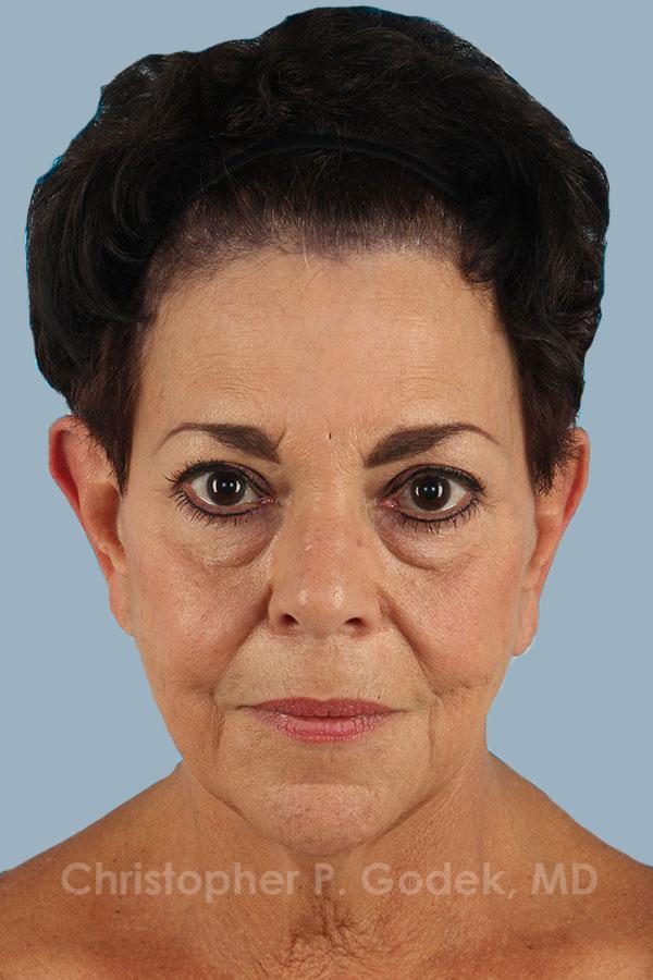 Facelift  Before & After Image