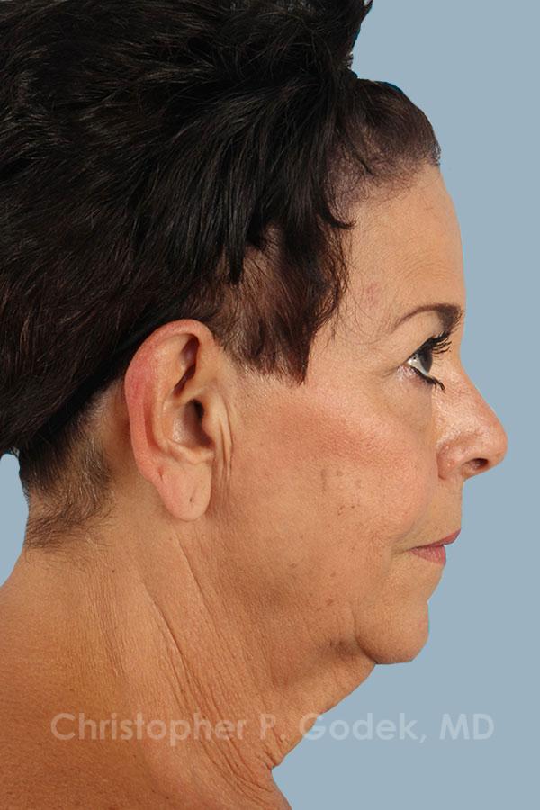 Facelift  Before & After Image