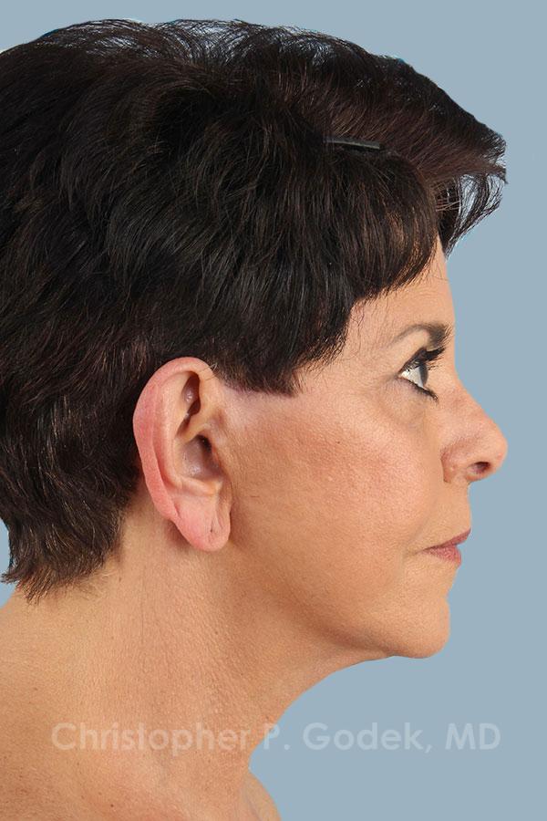 Facelift  Before & After Image