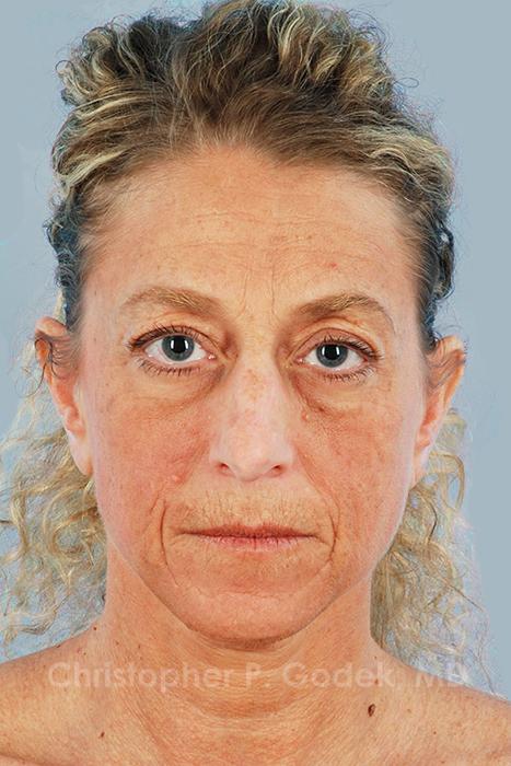 Facelift  Before & After Image