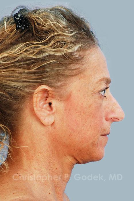 Facelift  Before & After Image