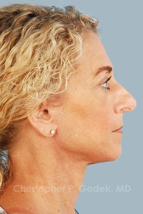 Facelift  Before & After Image