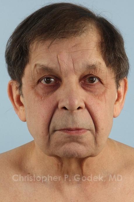 Facelift  Before & After Image