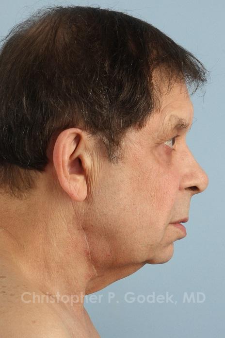 Facelift  Before & After Image