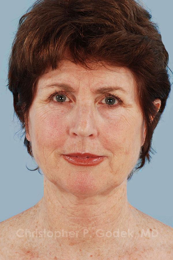 Facelift  Before & After Image