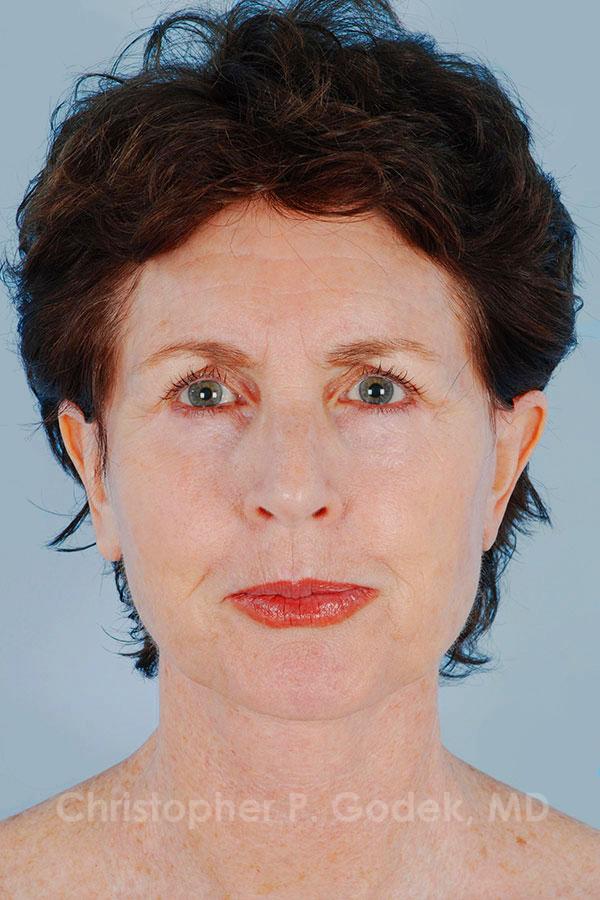 Facelift  Before & After Image