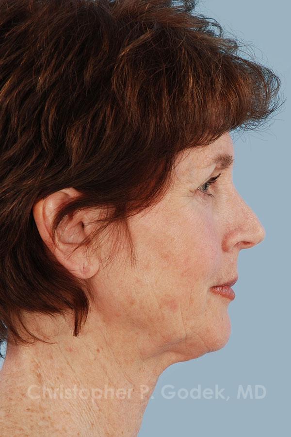 Facelift  Before & After Image