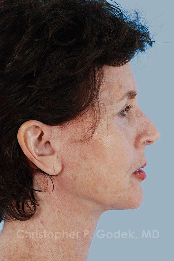 Facelift  Before & After Image