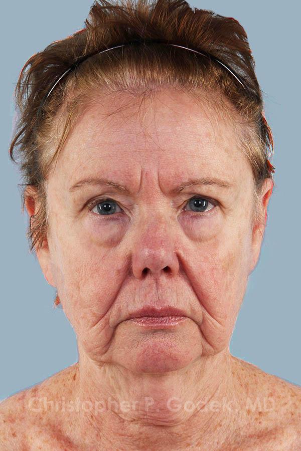 Facelift  Before & After Image