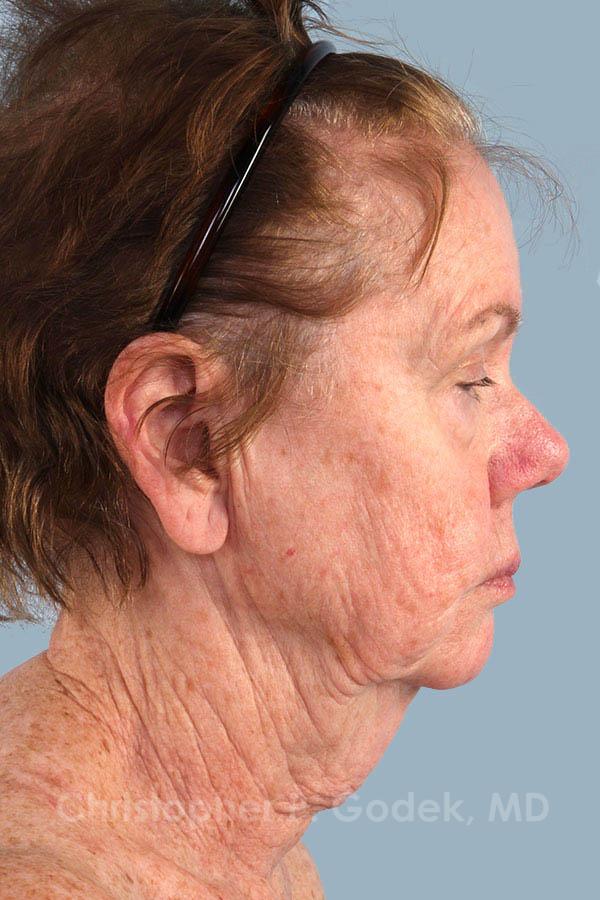 Facelift  Before & After Image