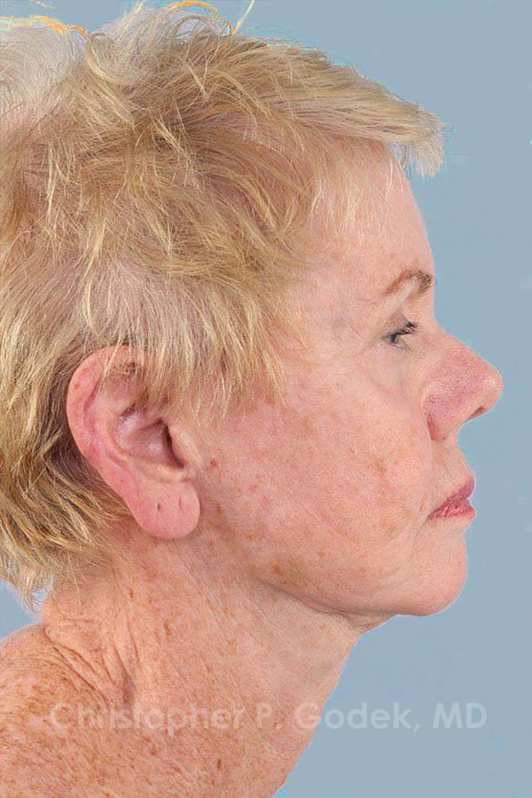 Facelift  Before & After Image