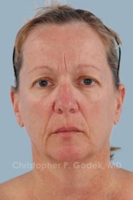 Facelift  Before & After Image