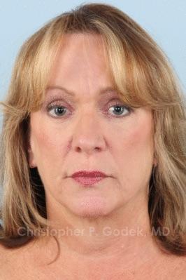 Facelift  Before & After Image