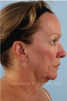 Facelift  Before & After Image