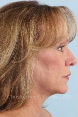 Facelift  Before & After Image