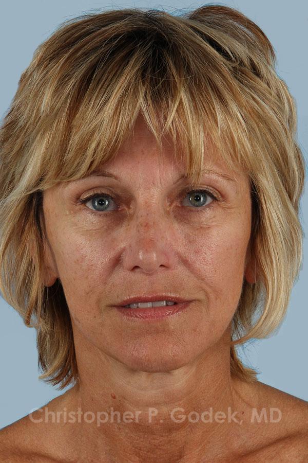 Facelift  Before & After Image