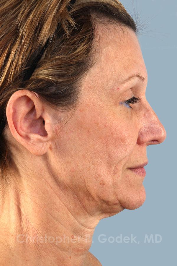 Facelift  Before & After Image