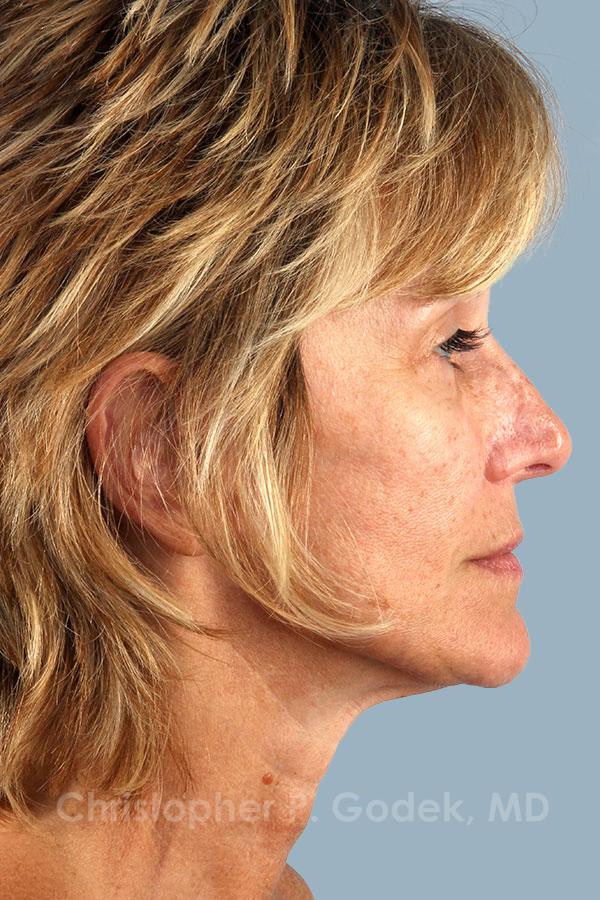 Facelift  Before & After Image