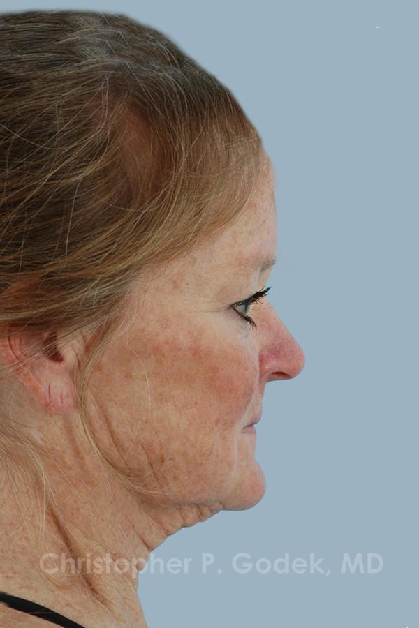 Facelift  Before & After Image