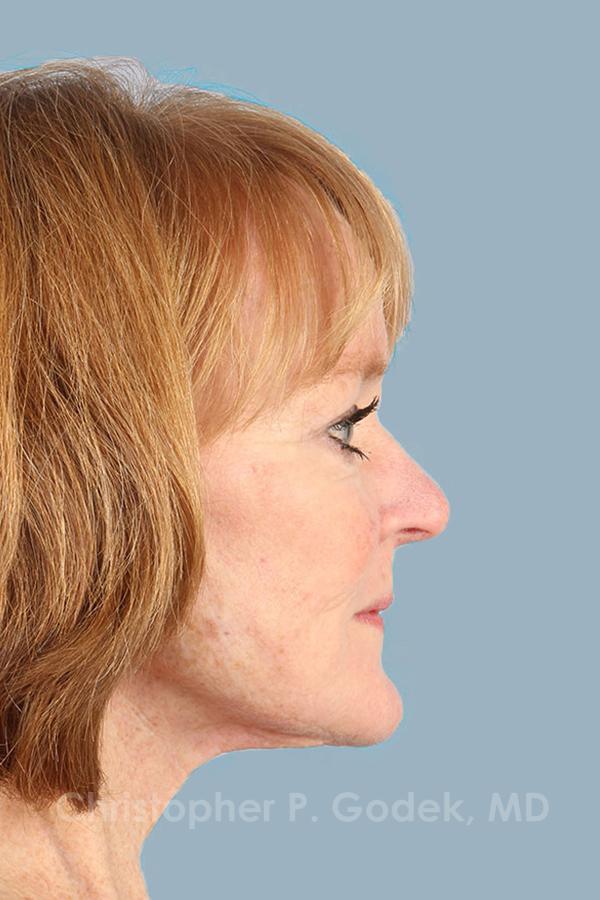 Facelift  Before & After Image