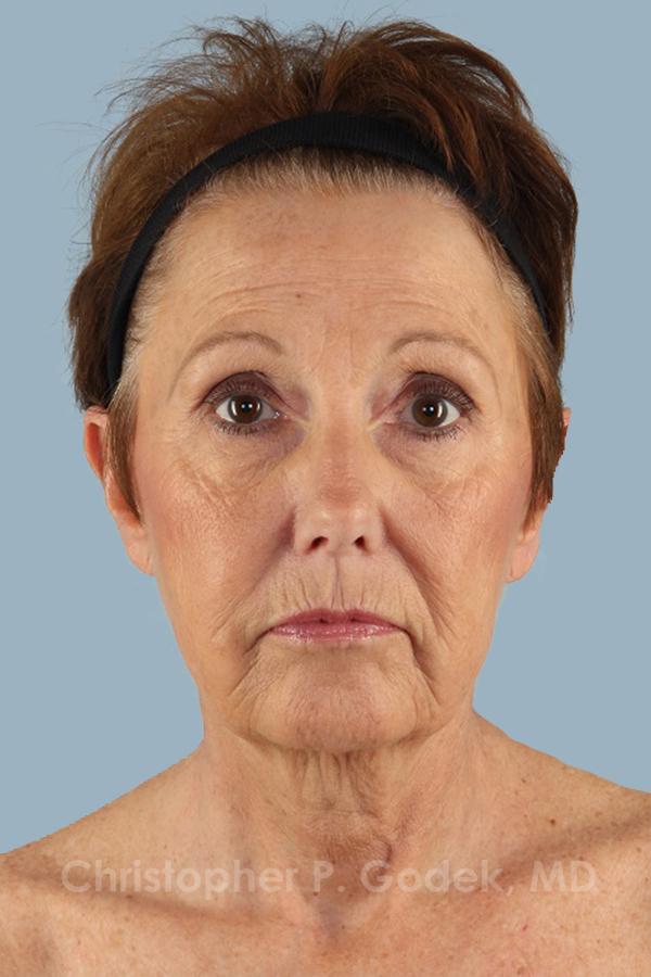 Facelift  Before & After Image