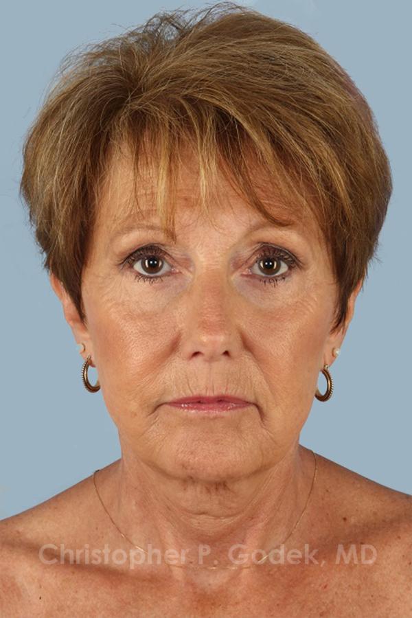 Facelift  Before & After Image