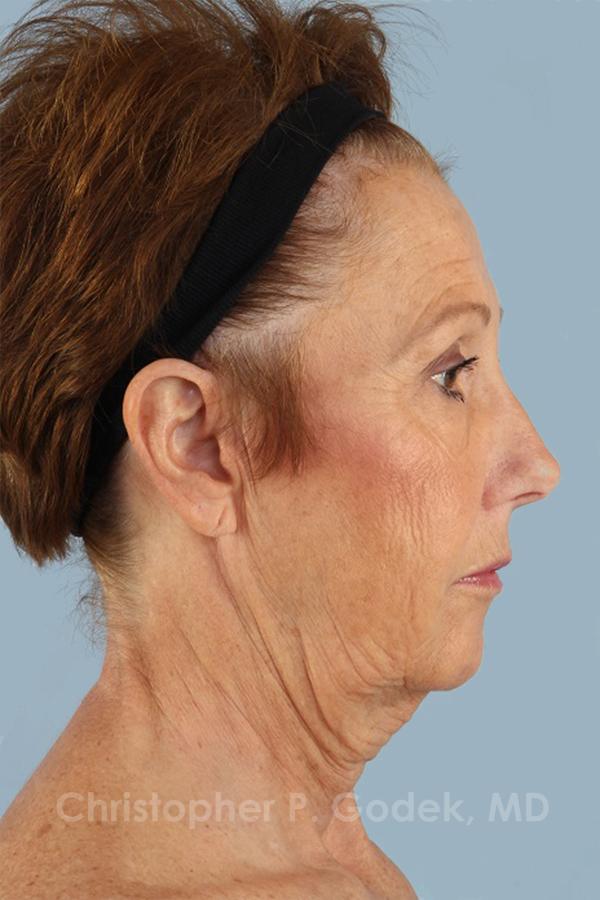 Facelift  Before & After Image