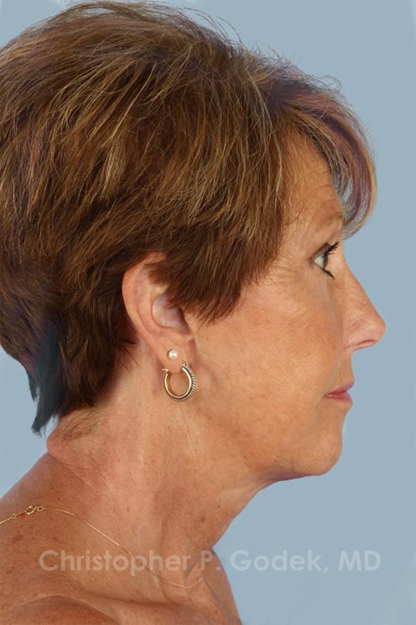 Facelift  Before & After Image