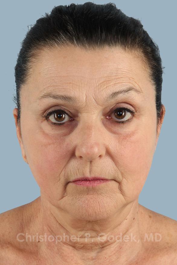 Facelift  Before & After Image