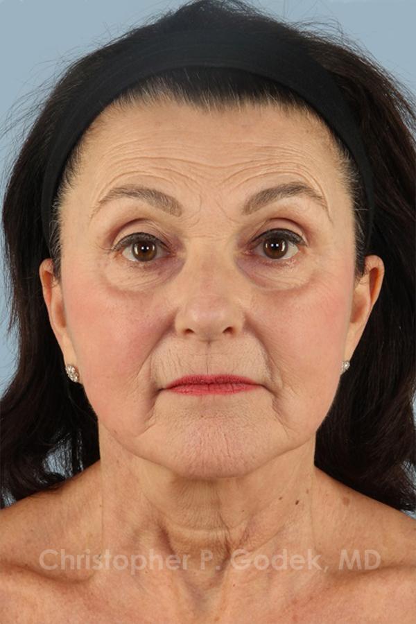 Facelift  Before & After Image