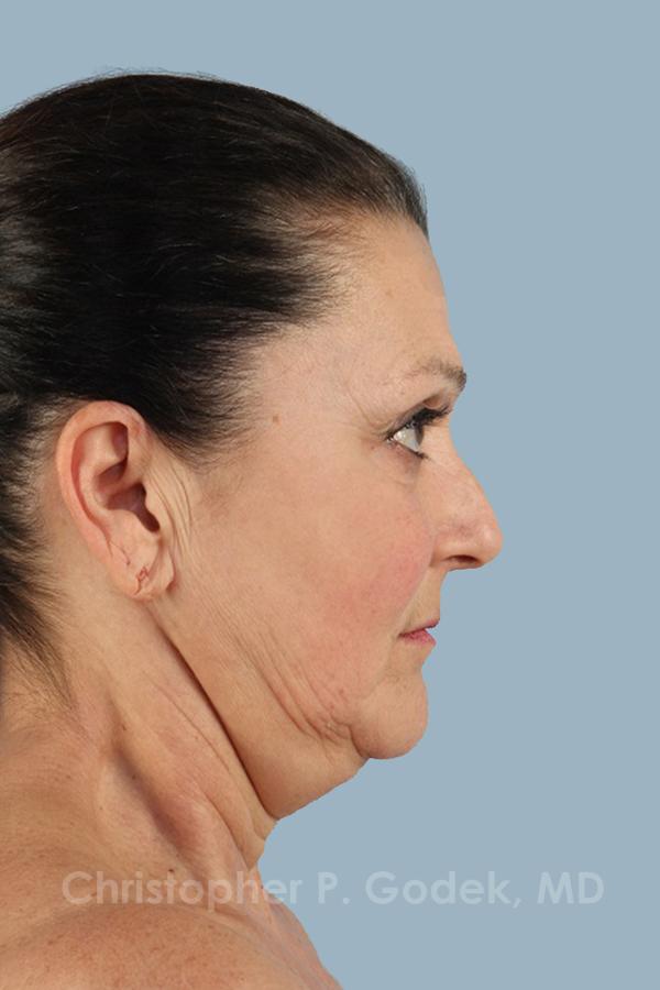 Facelift  Before & After Image