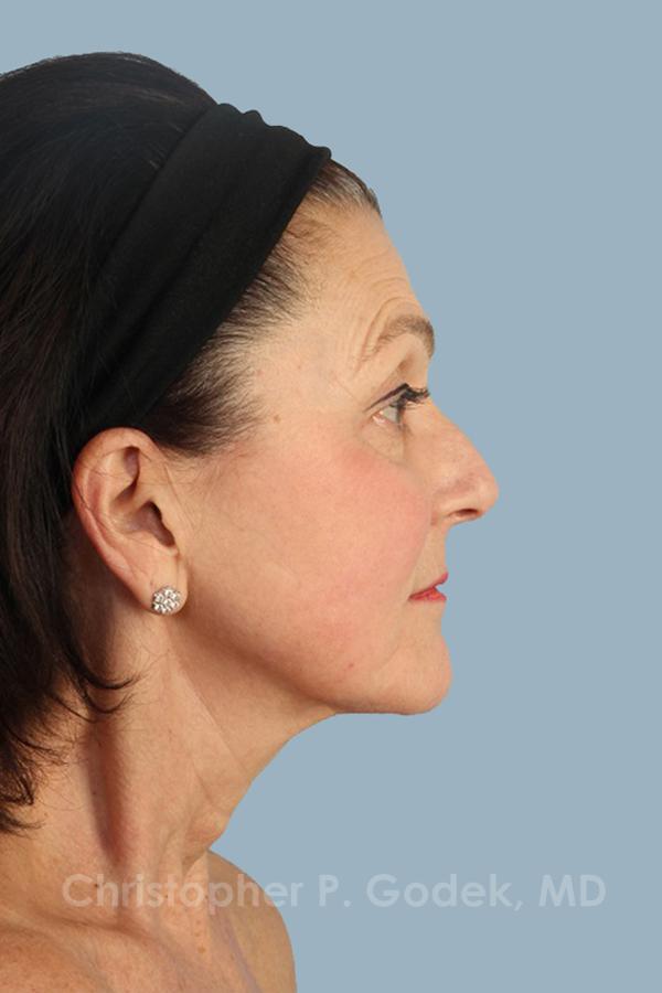 Facelift  Before & After Image