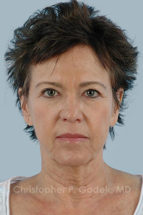 Facelift  Before & After Image