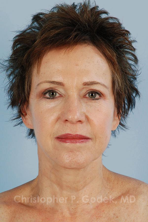 Facelift  Before & After Image