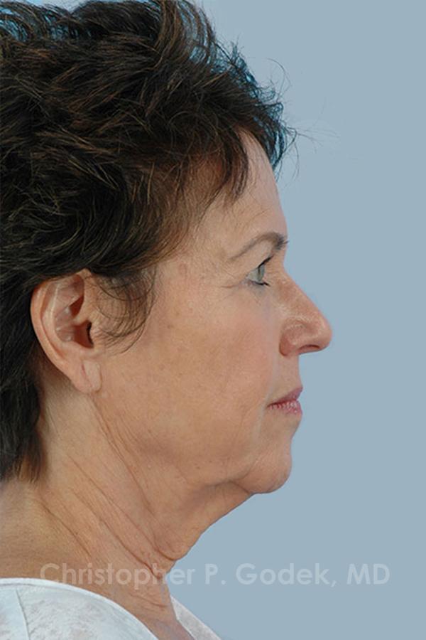 Facelift  Before & After Image