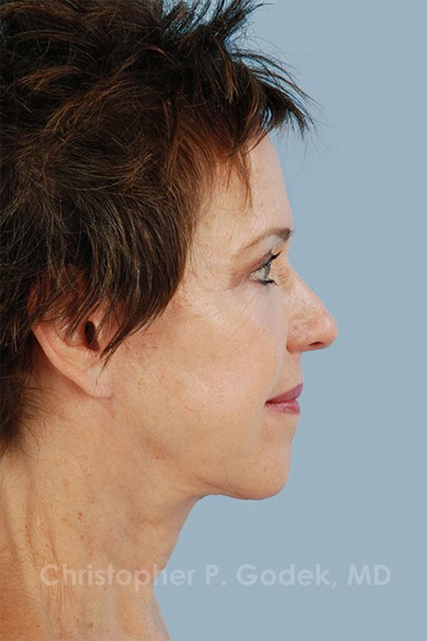 Facelift  Before & After Image