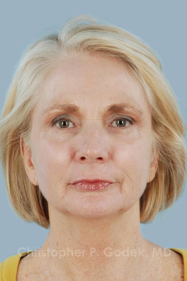Laser Resurfacing Before & After Image