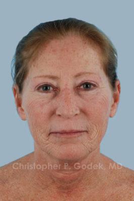 Laser Resurfacing Before & After Image