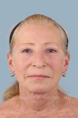 Laser Resurfacing Before & After Image